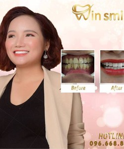 LÀM RĂNG Thay phong thủy, thay đổi vận mệnh tại Win Smile, tại sao không