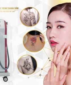 Máy laser Toning KH9 xóa xăm, điều trị sắc tố