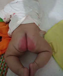 Tất tần tật cách trị hăm cho bé trai từ A Z