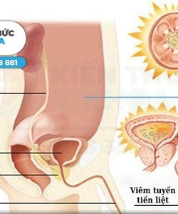 Điều trị viêm đường tiết niệu hiệu quả tại TP Thanh Hóa