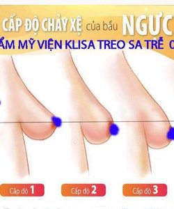 Treo Sa trễ không đặt túi giảm giá chỉ còn từ 10 triệu tại thẩm mỹ viện Klisa