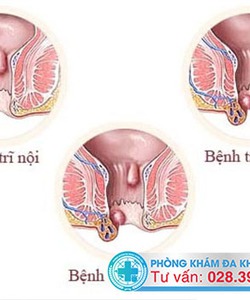 Mách bạn sản phẩm Antrinano Plus trị trĩ tuyệt vời