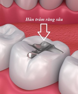 Dịch vụ trám răng sâu uy tin