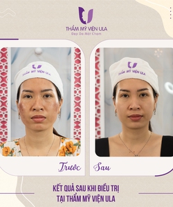 Hé lộ sự thật đằng sau việc trị mụn tại thẩm mỹ viện: nên hay không nên