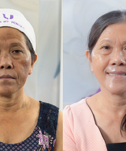 Địa chỉ trị nám tàn nhang uy tín được hàng nghìn khách hàng lựa chọn