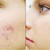 Kem-tri-seo-Scar-Esthetique