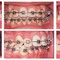 Niềng răng ở đâu tốt nhất tháng 6